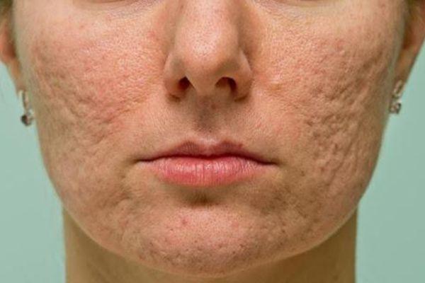 Điều trị sẹo lõm chi tiết bạn nên nằm lòng