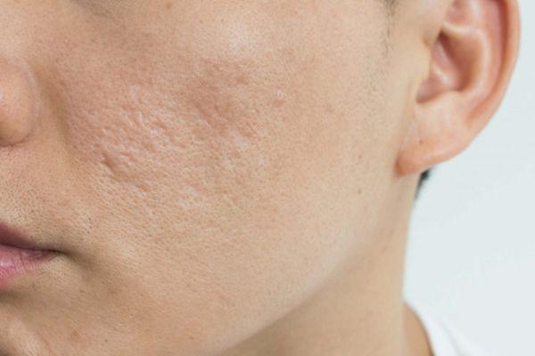 Trị sẹo mụn lõm tại nhà thế nào là tốt nhất?