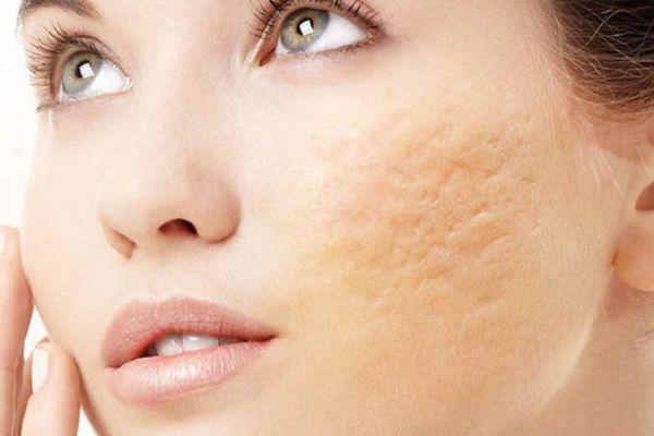 Những điều cần lưu ý quan trọng khi chữa sẹo mụn lõm