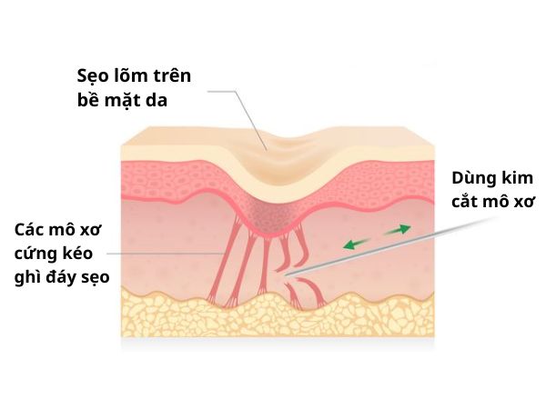Quá trình bóc tách đáy sẹo lõm