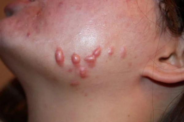 Sẹo do mụn và những thông tin cơ bản cần nắm