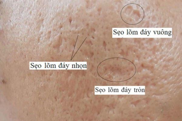 Những dạng sẹo do mụn thường gặp nhất