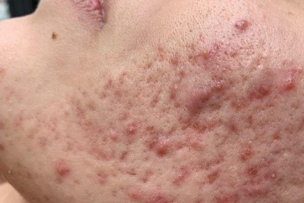 Trị thâm sẹo do mụn thế nào tại nhà mới hiệu quả?
