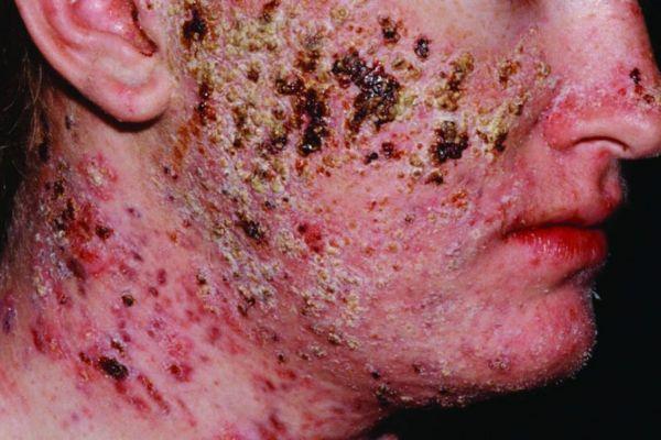 Cách điều trị mụn do sẹo chuẩn y khoa chi tiết