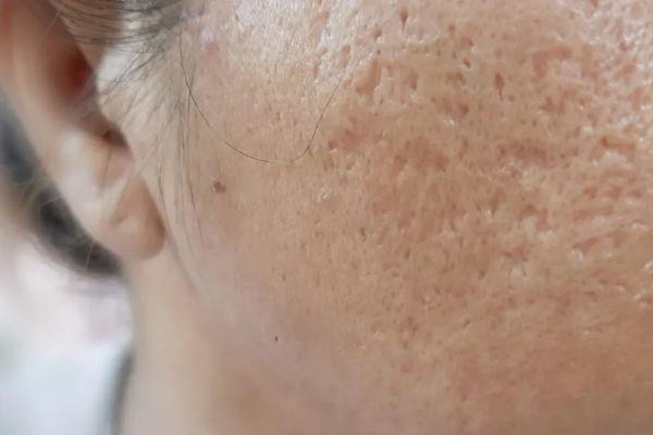 Điều cần lưu ý để sẹo thâm do mụn mờ nhanh hơn