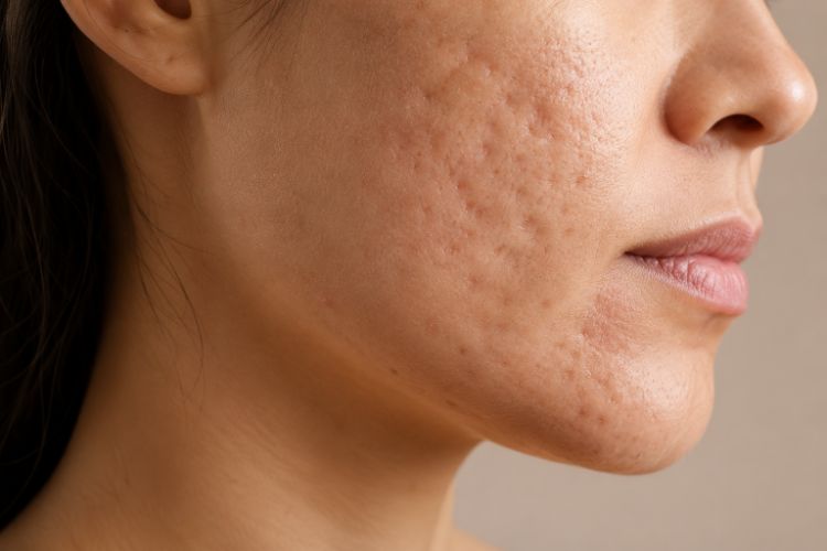 Sẹo mụn có thể khiến bề mặt da lõm, gồ hoặc không bằng phẳng
