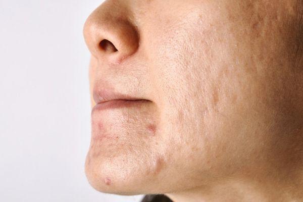 Sẹo Mụn Hình Thành Do Đâu Và Cách Cải Thiện Nhanh Chóng