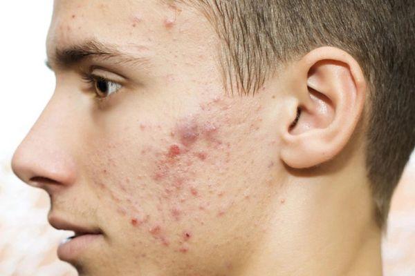Điểm danh những loại sẹo thâm mụn và phân biệt