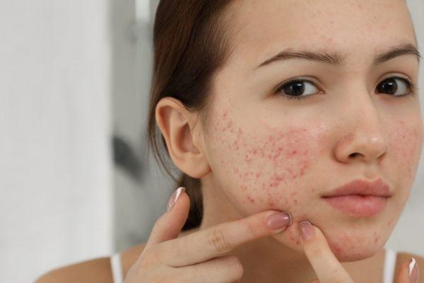 Trị sẹo mụn gây thâm thế nào mới thực sự hiệu quả?