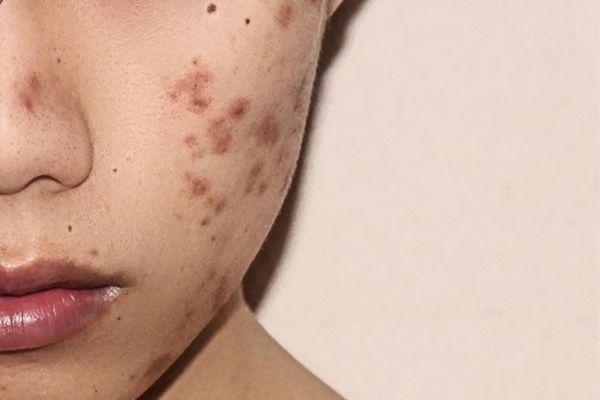 Quy trình 4 bước hỗ trợ điều trị mụn thâm cùng Citrine