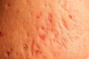 Sẹo Mụn Thâm Lâu Năm Có Trị Được Không Và Cách Xử Lý