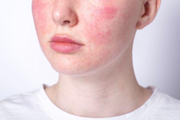 Cơ địa da nhạy cảm dễ sưng đỏ hơn sau tái tạo