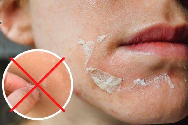 Không tự ý bóc da bong sau tái tạo tránh thâm sẹo