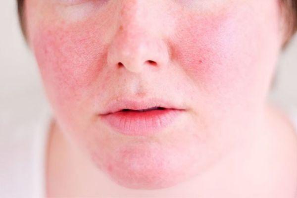 Tái tạo da bị sưng đỏ ngứa có sao không? Cách xử lý an toàn