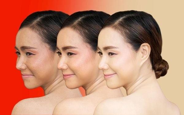 Tái tạo da được cải thiện rõ rệt dần theo thời gian