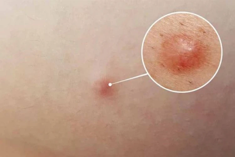 Thế nào là mụn bị chai cứng dưới da chi tiết?