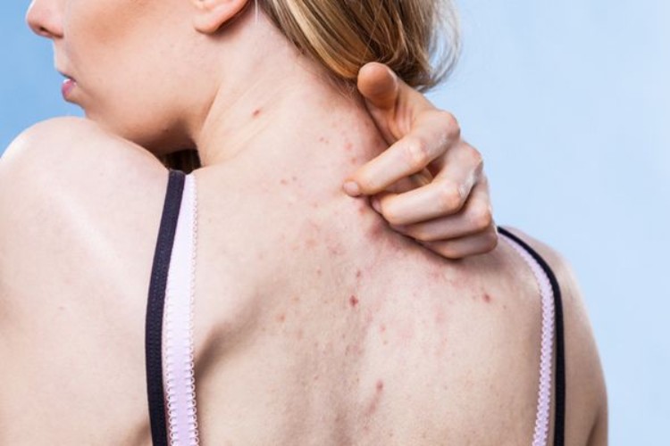 Thế nào là mụn lưng trên da?