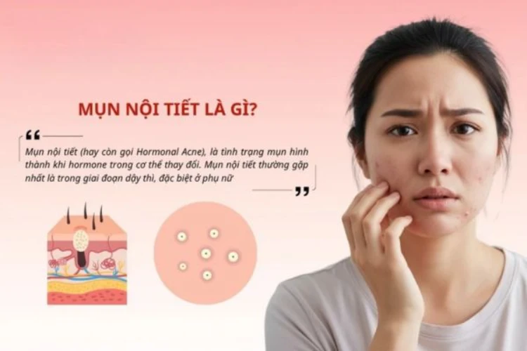 Thế nào là mụn nội tiết trên da?
