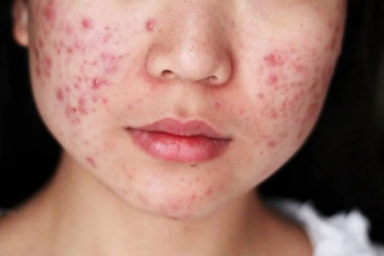 Thế nào là tình trạng mụn trứng cá trên da?