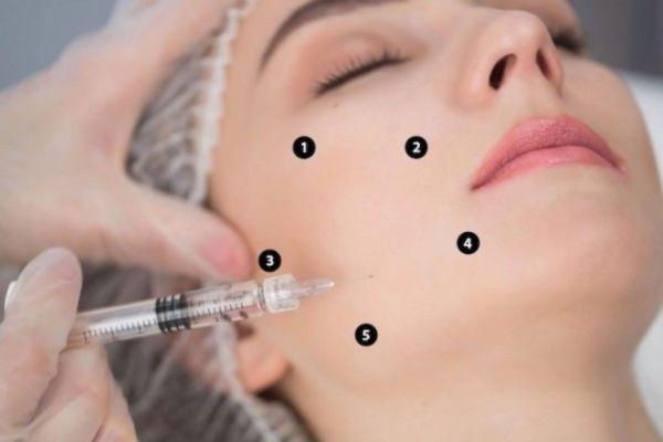 Profhilo B.A.P dưỡng ẩm sâu và tái tạo da từ bên trong