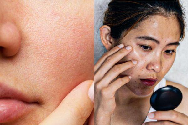 So sánh Profhilo và Jalupro giúp chọn đúng giải pháp cho da