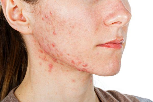 Người có viêm nhiễm cấp tính tại vùng da không nên tiêm
