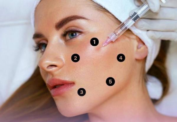 Xác định 5 điểm tiêm BAP Profhilo trên khuôn mặt