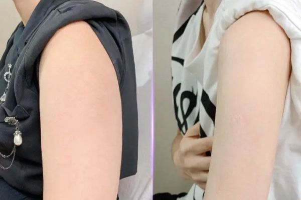Tiêm botox bắp tay thường thấy hiệu quả rõ sau khoảng 4–6 tuần