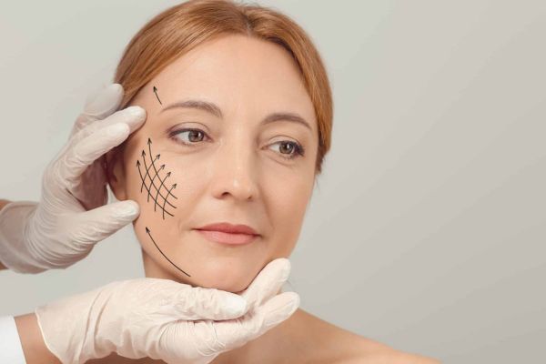 Hiệu quả Botox gọn hàm xuất hiện dần, rõ nhất sau khoảng 4–8 tuần