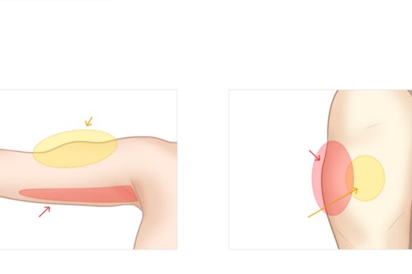Botox giúp bắp tay thon gọn bằng cách giảm hoạt động của cơ