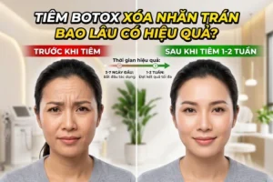 tiêm botox xóa nhăn trán bao lâu có hiệu quả