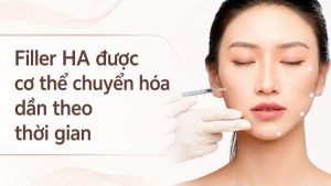 Filler HA được cơ thể chuyển hóa dần theo thời gian