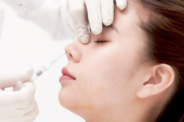 Tiêm filler mũi là nâng mũi không phẫu thuật, hiệu quả tạm thời