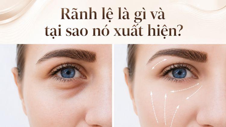 Rãnh lệ sâu khiến đôi mắt trông mệt mỏi hơn