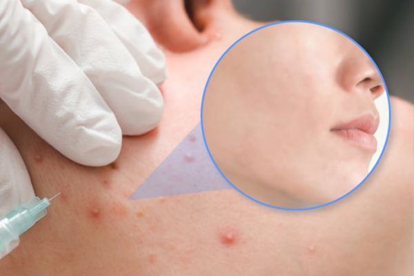 Meso mụn cải thiện sau vài tuần và đạt hiệu quả khi đủ liệu trình