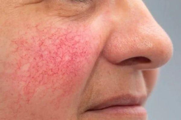 Tác dụng phụ laser thường nhẹ và kiểm soát được nếu làm đúng