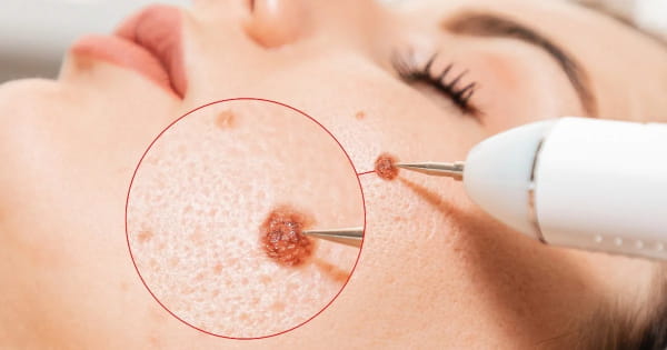 Liệu pháp áp lạnh trị sẹo sau phẫu thuật