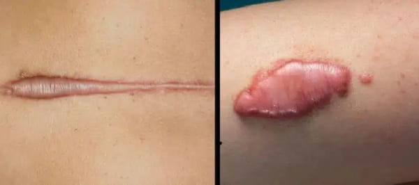 Sẹo phì đại (bên trái) và sẹo lồi (bên phải)