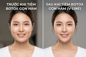 Trước và sau khi tiêm botox gọn hàm