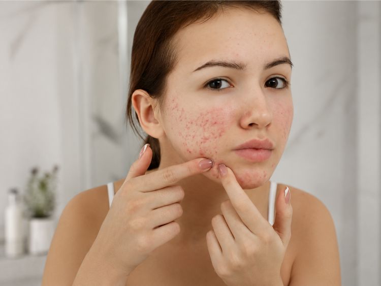 Tự nặn mụn và dùng nhiều hoạt chất có thể khiến da tổn thương hơn