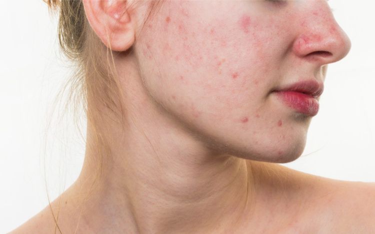 Vết đỏ sau mụn thường phẳng và liên quan đến phản ứng còn lại sau viêm