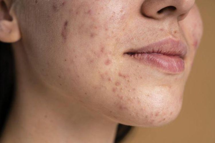 Vết thâm sẫm màu thường liên quan đến tăng sắc tố sau viêm