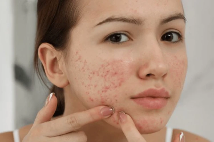 Vị trí của từng nốt mụn phản ánh sức khỏe bên trong