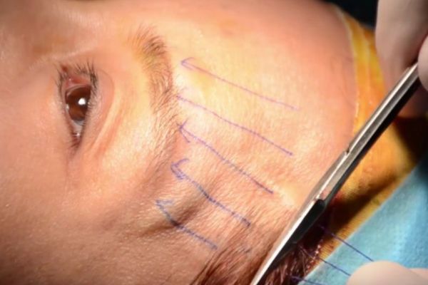 Yếu tố ảnh hưởng tới kết quả thẩm mỹ chân mày cụ thể