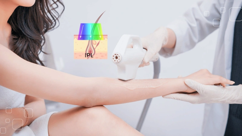 Triệt lông IPL có bị thâm không?
