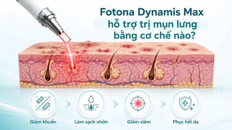 Fotona Dynamis Max hỗ trợ cải thiện nền da mụn