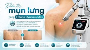 điều trị mụn lưng bằng Fotona Dynamis Max