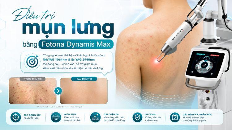điều trị mụn lưng bằng Fotona Dynamis Max