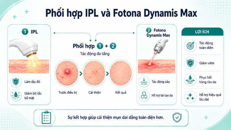Kết hợp IPL và Fotona hỗ trợ kiểm soát mụn