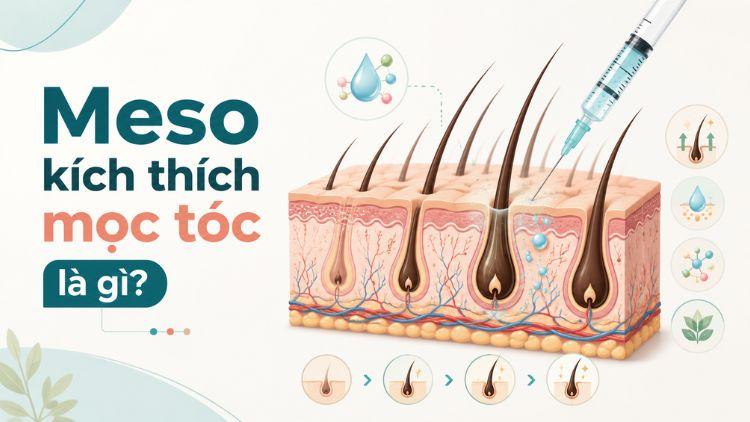 Meso đưa hoạt chất hỗ trợ vào vùng da đầu để kích mọc tóc